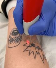 ENDLICH OHNE Tattooentfernung Berlin Bild 2