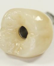 DIE MONOLITHISCH OKKLUSAL VERSCHRAUBTE IMPLANTATKRONE