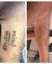 Removery Tattoo Removal & Fading image 6
