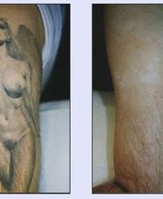 Tattooentfernung VN 5.jpg