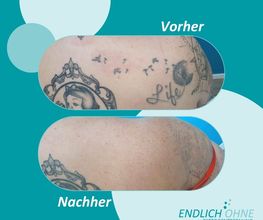 ENDLICH OHNE Tattooentfernung Filiale Dresden/Pirna Bild 2