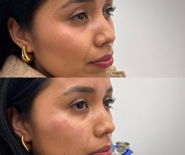Juvenalia Brío | Botox, Hydrafacial & Ultraformer - Condesa / Roma Norte CDMX imagen 3