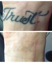 Removery Tattoo Removal & Fading image 10
