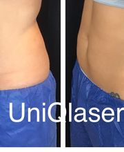 UniQ Laser Center Watertown image 13