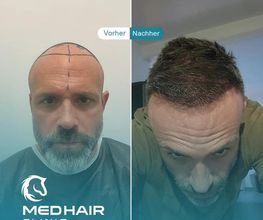 MedHair Clinic | Haartransplantationen in der Türkei Istanbul Bild 9