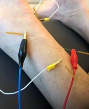 ITES/EA Achillodynie Behandlung