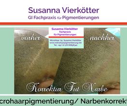 Microhaar Verdichtung 25 Narbenkorrektur