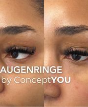 Augenringe unterspritzen mit Hyaluronsäure in Zürich