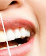 Bleaching
Dental Team Palace