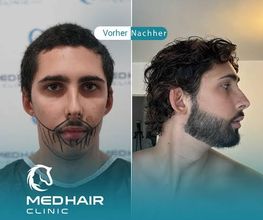MedHair Clinic | Haartransplantationen in der Türkei Istanbul Bild 4