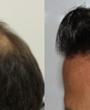 Fue Methode Basel Region Haare Haarverpflanzung