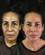 Instituto Marzola | Harmonização Facial imagen 14