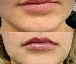 Juvenalia Brío | Botox, Hydrafacial & Ultraformer - Condesa / Roma Norte CDMX imagen 4