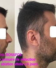 Dr Eric BONAFOS Chirurgien Esthétique Montpellier Chirurgie de la face et du cou image 12