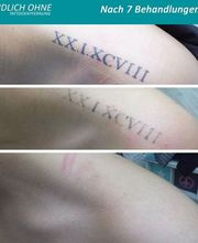 ENDLICH OHNE Tattooentfernung Berlin Bild 7