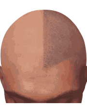 Hair clinic solution spécialiste en micropigmentation du cheveux à Marseille image 10