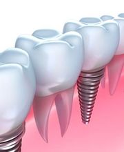 implantes1-637x399.jpg