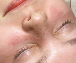 Fake Freckles - Skink Studio - Studio für Permanent Make-up in Köln