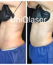 UniQ Laser Center Watertown image 15