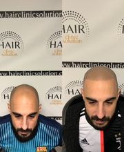 Hair clinic solution spécialiste en micropigmentation du cheveux à Marseille image 13