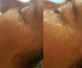 Resultaat na 1x HydroPeptide behandeling