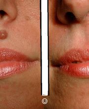 Ablation grain beauté au laser