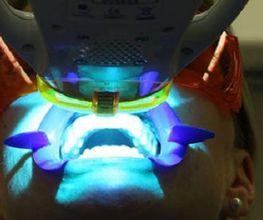 centre-odontologia-miret-puig-blanqueamiento-dental-02.jpg