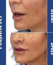 Dr Philippe Legaillard | Chirurgien esthétique Bordeaux | Lifting | Paupières | Rhinoplastie | Augmentation mammaire | Botox image 13
