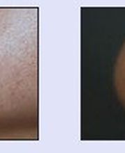 Haarentfernung VN 2.jpg