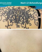 ENDLICH OHNE Tattooentfernung Filiale Dresden/Pirna Bild 3