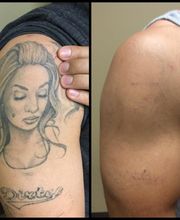 Removery Tattoo Removal & Fading image 3