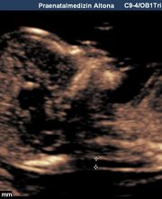 NT-Messung in SSW 13