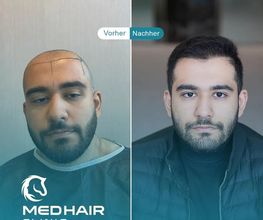 MedHair Clinic | Haartransplantationen in der Türkei Istanbul Bild 10