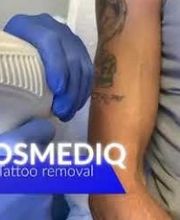 Tatoeage verwijderen cosmediq