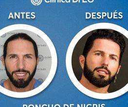 Clinica DrEO - Injerto de Cabello y Barba imagen 9
