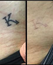 Removery Tattoo Removal & Fading image 6