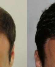 Fue Methode Basel Region Haare Haarverpflanzung