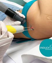 ENDLICH OHNE Tattooentfernung Berlin Bild 4