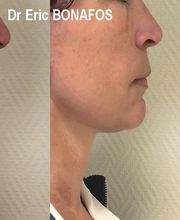 Dr Eric BONAFOS Chirurgien Esthétique Montpellier Chirurgie de la face et du cou image 9