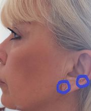 ISA Auriculothérapie image 10