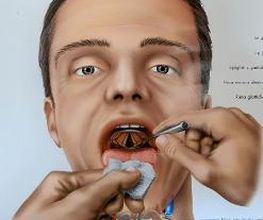 Kehlkopfspiegelung zur Draufsicht auf die hier geöffneten Stimmlippen (Stimmbänder)