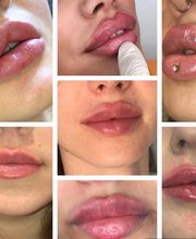 PrettyDoc Düsseldorf - Hyaluron und Botox Düsseldorf Bild 3
