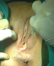 UNIDAD DE GINECOESTÉTICA LÁSER DR.FERNANDO AZNAR INSTITUTO CORDOBES DE GINECOLOGÍA imagen 2