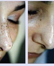 Pigmentflecken VN 2.jpg