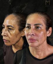 Instituto Marzola | Harmonização Facial imagen 12