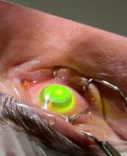 EyeLaser Zürich | Augenlasern & Linsenchirurgie Bild 2