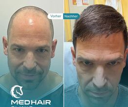 MedHair Clinic | Haartransplantationen in der Türkei Istanbul Bild 12