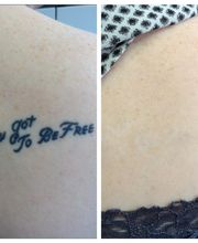 Removery Tattoo Removal & Fading image 7
