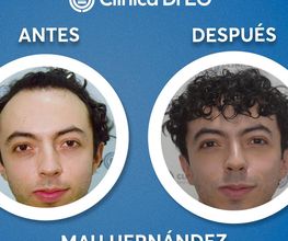 Clinica DrEO - Injerto de Cabello y Barba imagen 11