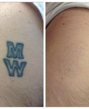 Removery Tattoo Removal & Fading image 5